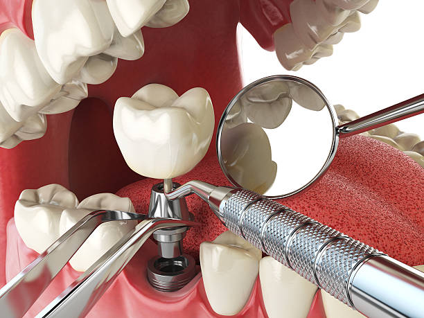 Best Emergency Tooth Extraction in Menomonee Falls, WI